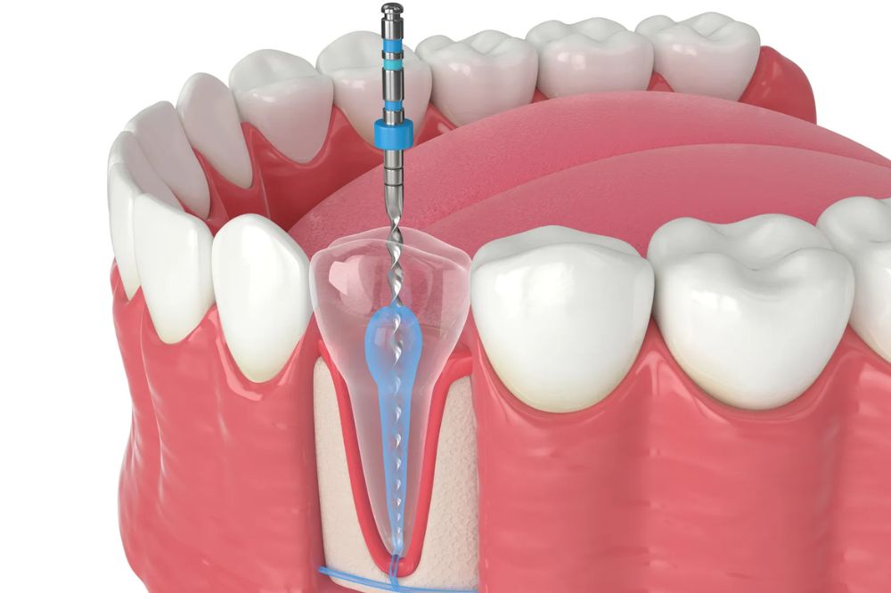 root canal treatment near you