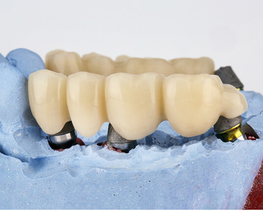 dental bridges in surrey