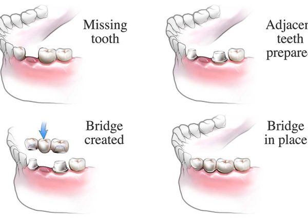 dental bridges near you