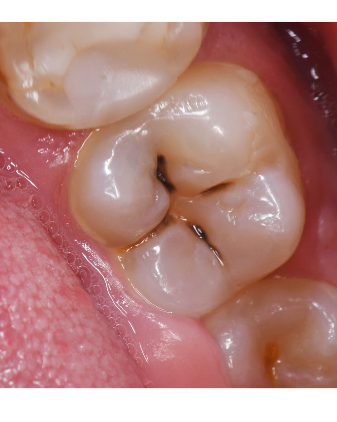 dental filling treatment in surrey