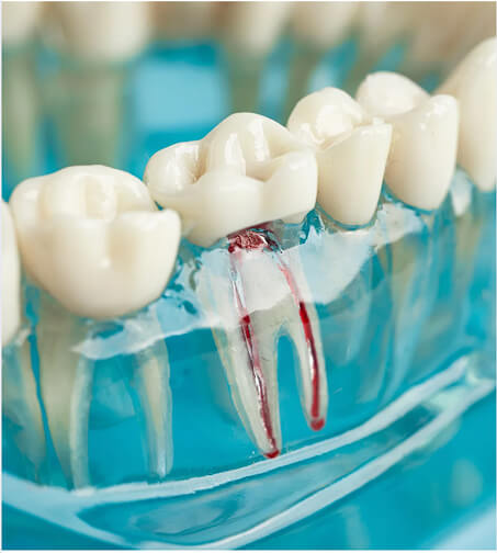 root canal treatment in surrey