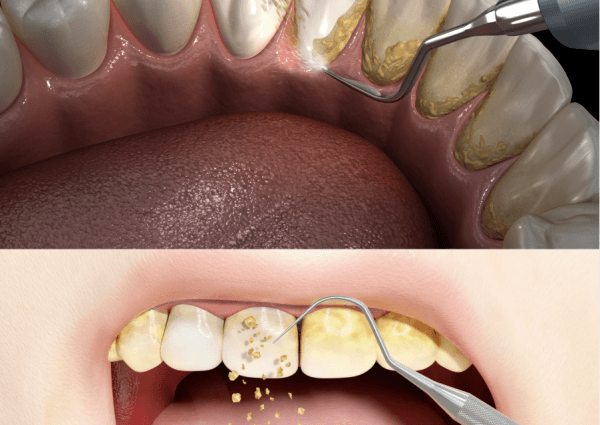 teeth cleaning treatment near you