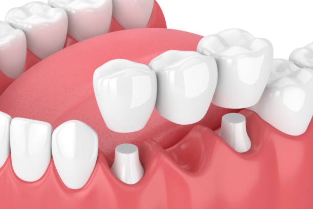 dental bridges in Surrey