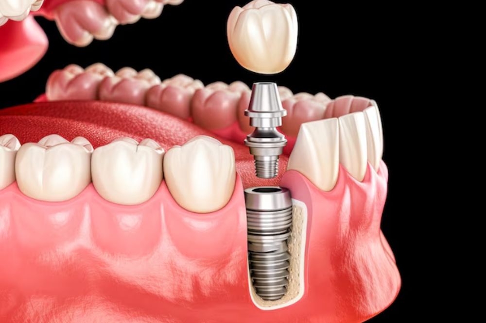 dental implants in Surrey