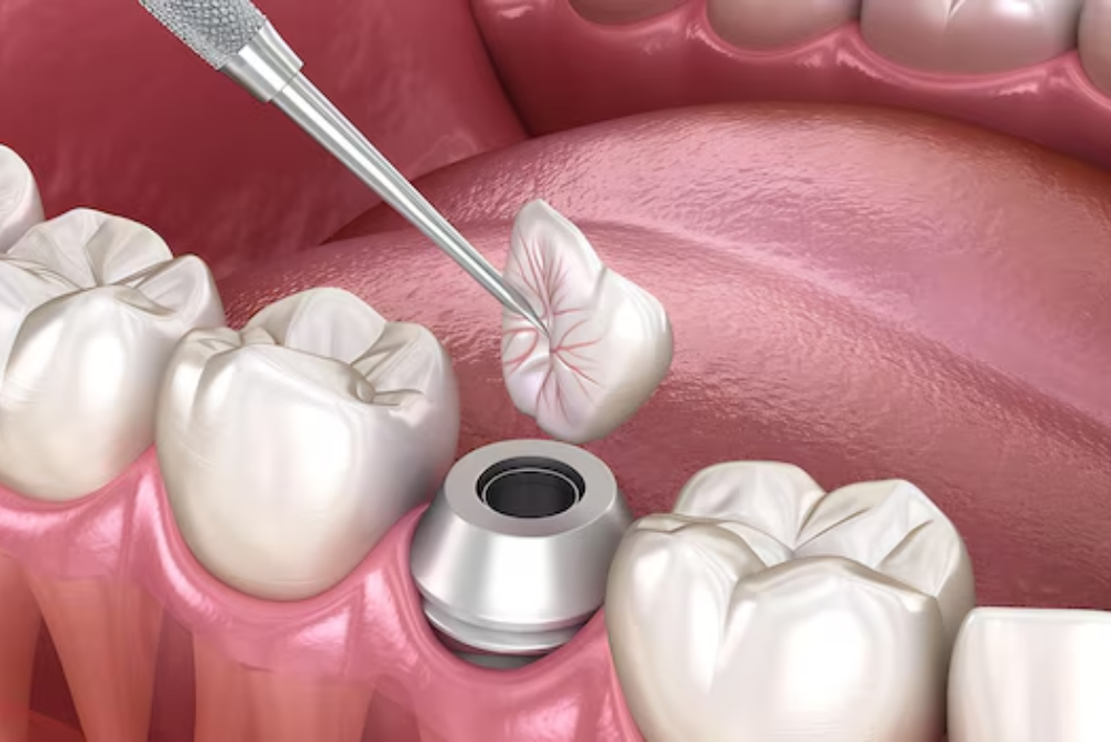 Tooth Extraction Surrey