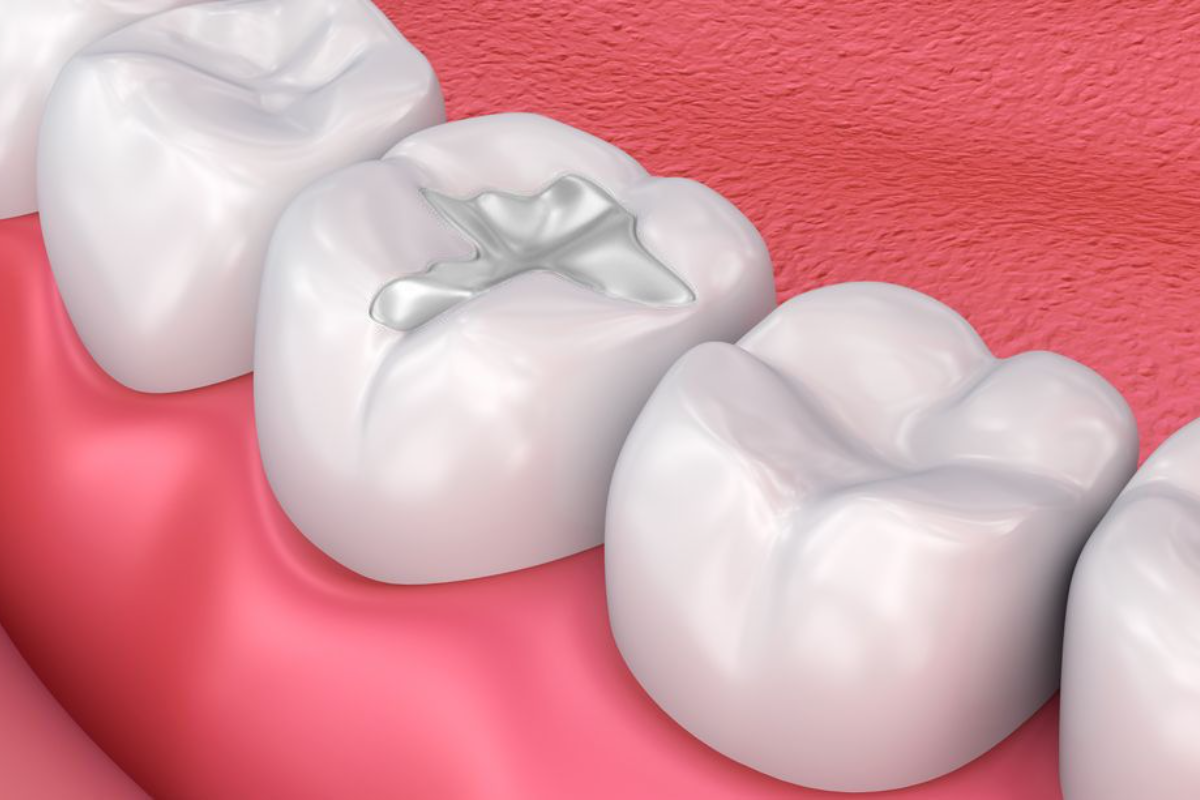 Dental Filling Treatment In Surrey