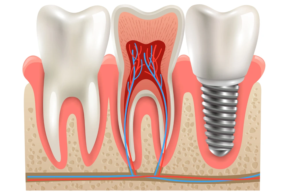 dental implant for missing tooth replacement