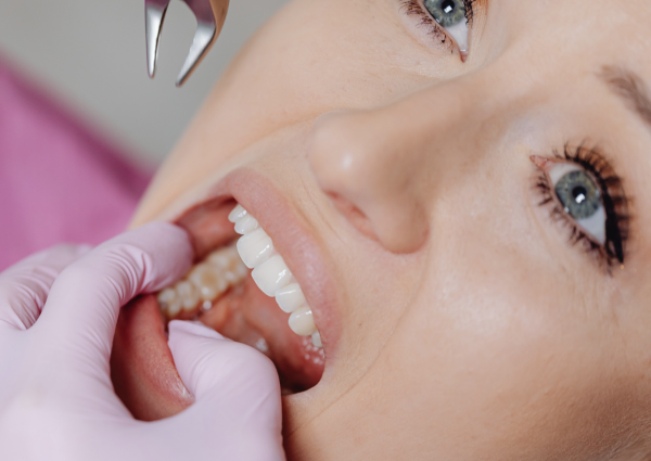 Tooth Extraction_2 Tooth Extractions in Clayton, Surrey, and Langley - Smile 64 Clayton Dental