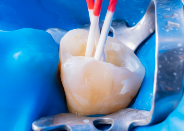 dental-filling-treatment-near-you dental filling treatment near you