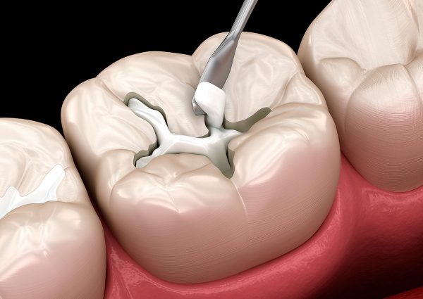 Dental Filling Treatment Near You
