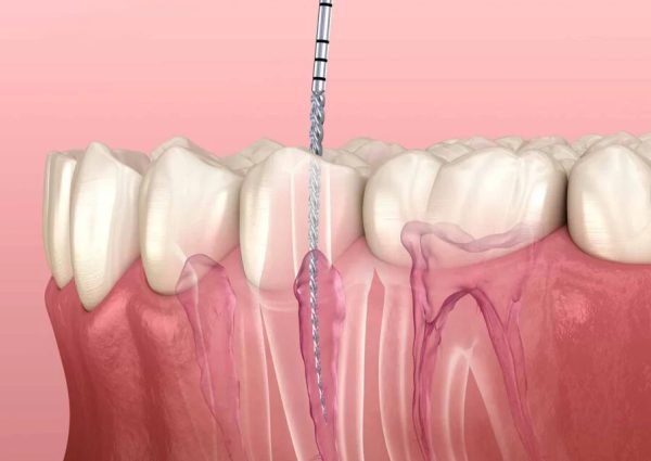 root-canal-treatment-in-surrey