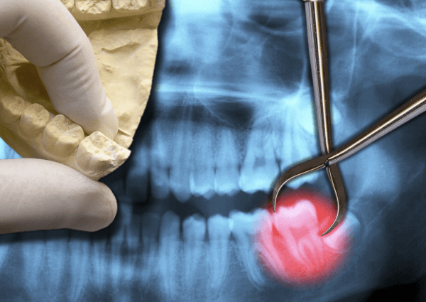 tooth-extraction-near-you tooth extraction near you